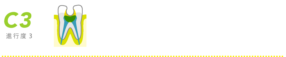 進行度3