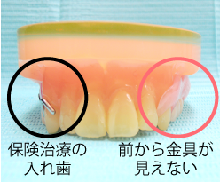 入れ歯の画像